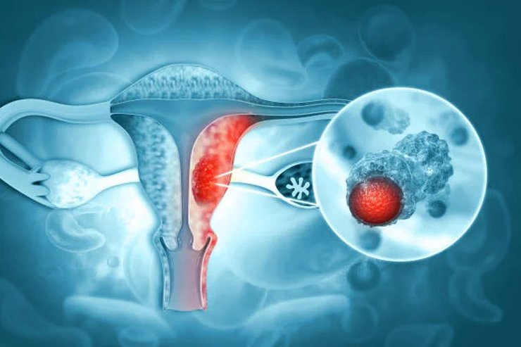 Cervical Cancer