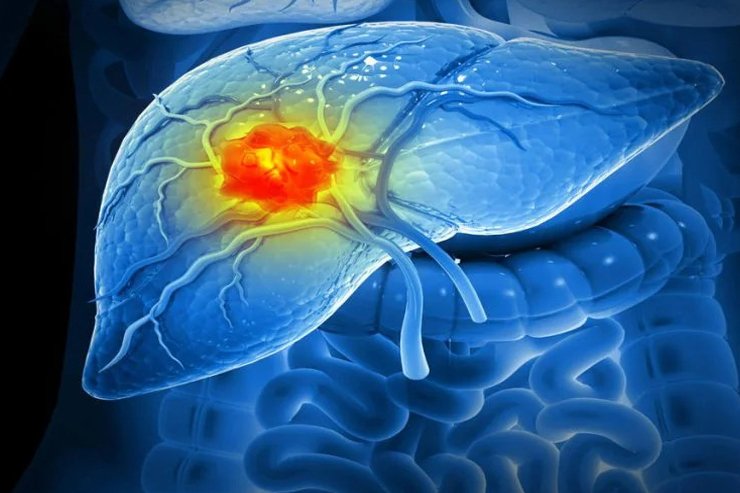 Liver Cancer 